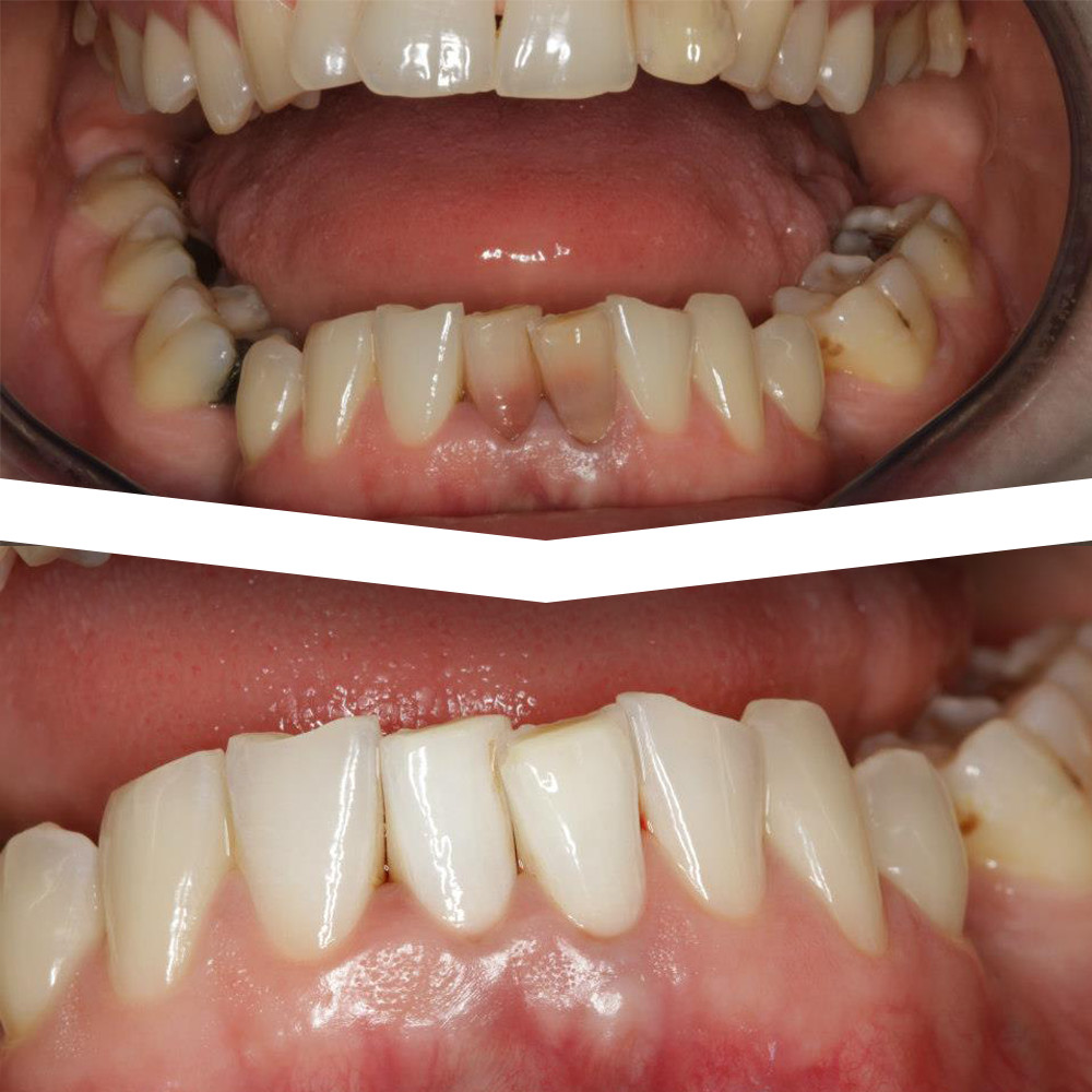 Before and After Photos of Dental Work by Marrero Dentists